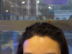 -碧莲盛·不剃发植发