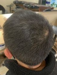 -碧莲盛·不剃发植发