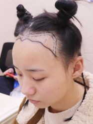 -大麦微针植发全国连锁