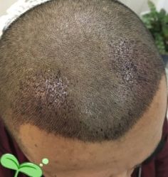 -大麦微针植发丨全国连锁