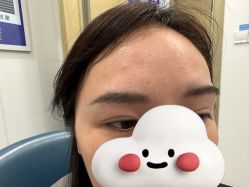 -大麦微针植发全国连锁