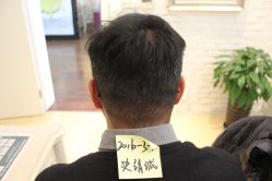 点击看大图 -大麦微针植发丨全国连锁