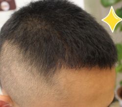 -大麦微针植发丨全国连锁