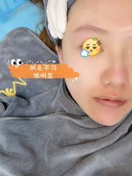 体验前-More摩尔医美の注射线雕光电中心