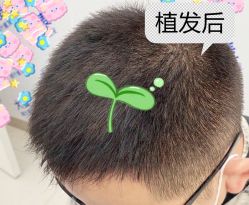 -大麦微针植发全国连锁