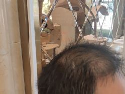 -碧莲盛·不剃发植发