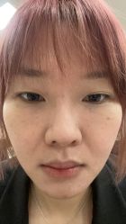 点击看大图 体验后-深圳阳光医疗美容医院·旗舰店