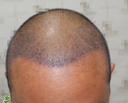 -大麦微针植发丨全国连锁