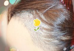 -大麦微针植发全国连锁