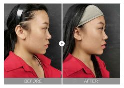 体验前-大华韩艺整形美容医院