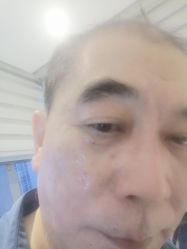 -美丽人生祛斑扁平疣汗管瘤中心
