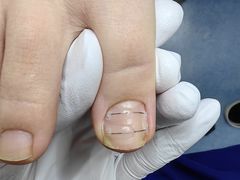 -Andrew指甲专科灰指甲·甲沟炎矫正·3D步态矫形鞋垫定制(上海法华镇路旗舰店)