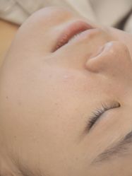 体验后-清疣美疣·痣·斑净肤中心