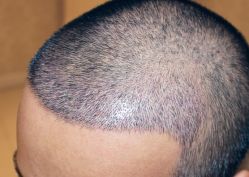 -大麦微针植发全国连锁