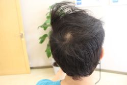 -大麦微针植发丨全国连锁