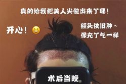 -碧莲盛·不剃发植发