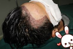 点击看大图 -大麦微针植发丨全国连锁