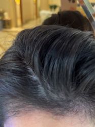 -碧莲盛·不剃发植发