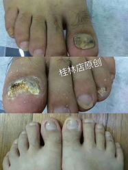 -德哥灰指甲脚气甲沟炎跖疣护理