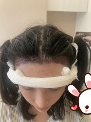 点击看大图 -大麦微针植发丨全国连锁