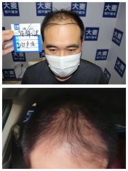 -大麦微针植发丨全国连锁