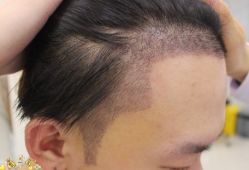 -大麦微针植发丨全国连锁