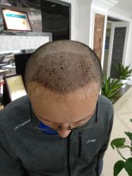 点击看大图 -大麦微针植发丨全国连锁