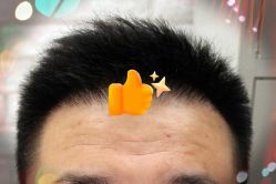 -大麦微针植发全国连锁