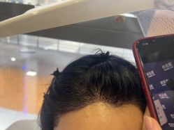 -碧莲盛·不剃发植发