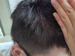 -碧莲盛·不剃发植发