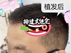 -大麦微针植发全国连锁