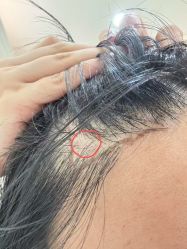 -碧莲盛·不剃发植发