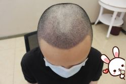 -大麦微针植发丨全国连锁