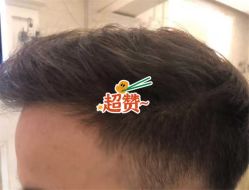 -大麦微针植发全国连锁
