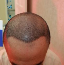 -大麦微针植发丨全国连锁