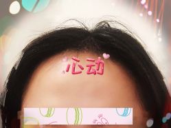 -大麦微针植发全国连锁