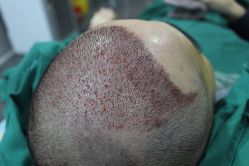 点击看大图 -大麦微针植发丨全国连锁