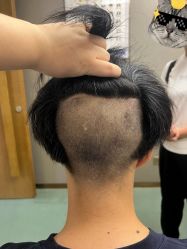 -大麦微针植发全国连锁