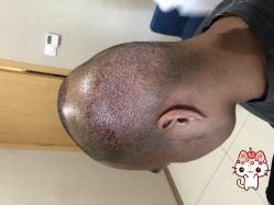 -大麦微针植发丨全国连锁