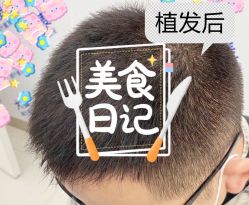 -大麦微针植发全国连锁