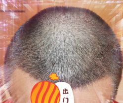 -大麦微针植发全国连锁