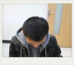 -大麦微针植发全国连锁