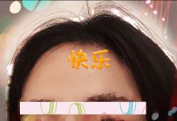 -大麦微针植发全国连锁