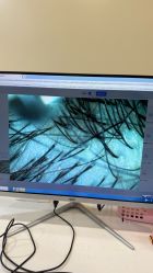 -碧莲盛·不剃发植发