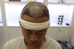 -大麦微针植发丨全国连锁