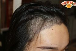 -大麦微针植发丨全国连锁