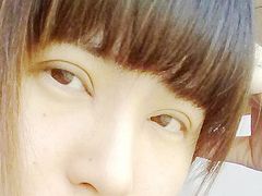 刚开好20天后的样子-上海华安整形外科门诊部