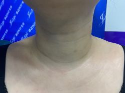 体验前-郡艺医疗美容·微整·眼鼻吸脂