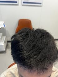 -大麦微针植发全国连锁
