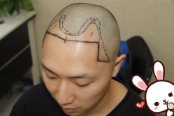 点击看大图 -大麦微针植发丨全国连锁